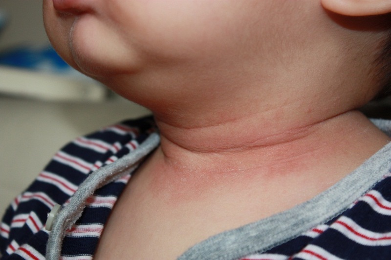 赤ちゃんの首が赤いし臭い原因と改善策を３種紹介 速報 スクープちゃんニュース