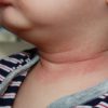 赤ちゃんの首が赤いし臭い原因と改善策を３種紹介